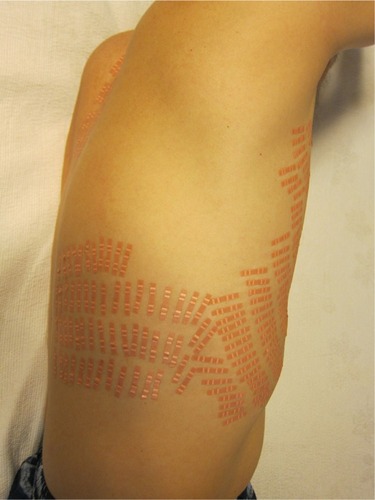 Figure 3 Attachment of type C of chimsband on the sides for depression.