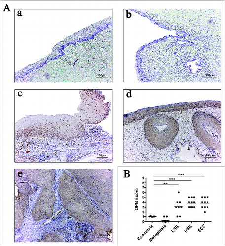 Figure 6. OPG expression is increased in (pre)neoplastic cervical lesions compared to normal tissues but, remains stable during cervical cancer progression. Representative images of OPG expression in exocervical epithelium (A), metaplasia (B), LSIL (C), HSIL (D) and SCC (E). The OPG immunoreactivity is observed in the epithelial compartment. (F) Semi-quantitative analysis shows a significant increased OPG expression in metaplasia (n = 9), LSIL (n = 8), HSIL (n = 11) and SCC (n = 10) compared to the exocervix (n = 5). Asterisks indicate statistically significant differences (**P < 0.01; ***P < 0.001). Original magnification: X100.