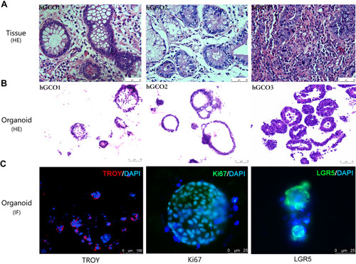 Figure 2 Representative image of gastric cancer tissues and organoids. Pathological analysis of the established gastric cancer organoids. (A and B) H&E staining of gastric cancer tissues (scale bar, 50 μm) and organoids (scale bar, 75 μm). Gastric cancer tissues and organoids show similar histological features. (C) Immunofluorescence staining of GC organoids. The left merged Figure shows the gastric stem cell marker TROY (red) and nuclear staining DAPI (blue) (scale bar, 100 μm), the middle merged figure shows the proliferation of gastric cancer organoids lines as measured by ki-67 (green) and nuclear staining DAPI (blue) (scale bar, 25 μm), and the right merged figure shows the stem cells in gastric cancer organoids lines as measured by LGR5(green) and nuclear staining DAPI (blue) (scale bar, 25 μm).