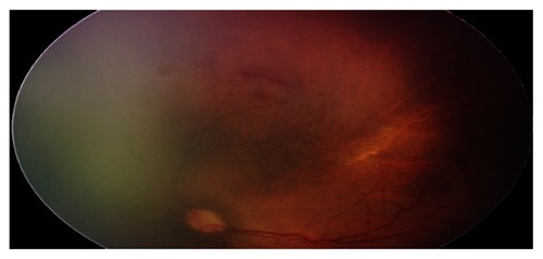 Figure 2 Prethreshold disease (OS stage 2, zone I, preretinal hemorrhages, plus sign).