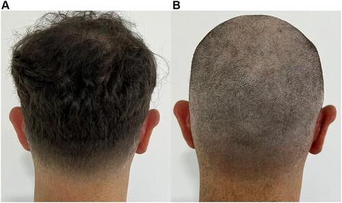 Figure 10 Photographs of patient 9 showing the back of his head before shaving (A) and after shaving, which shows thick, uniform hair flow (B).