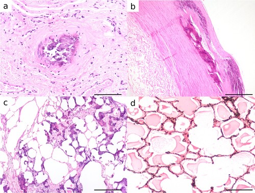 Figure 2. Photomicrographs of tissues from Toggenburg goats with soft tissue mineralisation. a) Mineralisation of small muscular artery in the abomasal submucosa in an 11-year-old female goat (H&E; bar = 100 μm). b) Osteochondroid metaplasia of aorta with osteoid in areas where vessels have infiltrated mineralised foci in a 6-year-old male goat (H&E; bar = 400 μm). c) Extensive basophilic amorphous mineral and early osseous metaplasia expanding alveolar septa of the lung in an 11-year-old female goat (H&E; bar = 400 μm). d) The presence of mineral in alveolar septa is highlighted by Von Kossa stain showing a honeycomb arrangement in a 9-year-old male goat (bar = 200 μm).