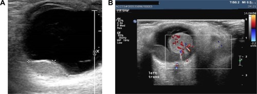 Figure 2 (A) Characteristic homogeneous appearance of choroidal melanoma on ultrasound scans; (B) application of Doppler technique depicting and enabling the study of tumor’s neovascularization.