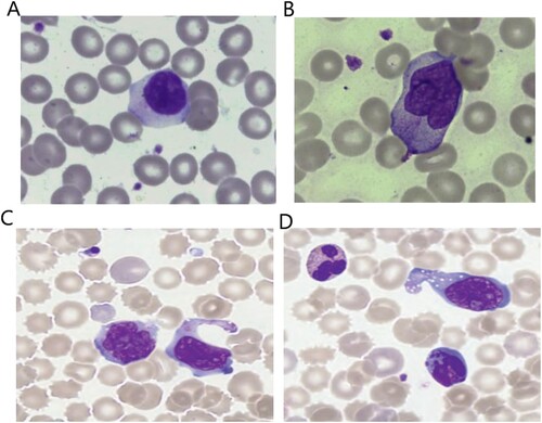 Figure 3. (A) The plasmacytoid lymphocyte, atypical lymphocyte with dark blue cytoplasm and slightly eccentric nucleus. (B) The monocytoid and ballerina looking lymphocytes were reactive lymphocytes that characteristically scalloping the neighboring cells, 100× magnification. (C) and (D) NK/T-cell lymphoma in leukaemic phase described by Leach M and Bain BJ, cited from the book ‘From the Image to the Diagnosis’, 1st edition. Page 58 [Citation25].