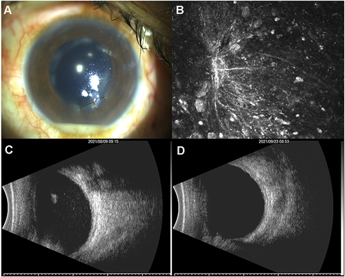 Figure 1 Ophthalmological examinations of the patient’s left eye.