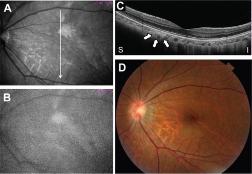 Figure 4 Fundus photographs of the left eye by near-infrared monochromatic light resistance (A), near-infrared fundus autofluorescence (B), optical coherence tomography (C), and color fundus photograph (D) of case 3. An optical coherence tomography image crossing the bright patchy regions (arrow in Figure 4A) shows an irregular hyper-reflectance focus in the choroid (Figure 4C).