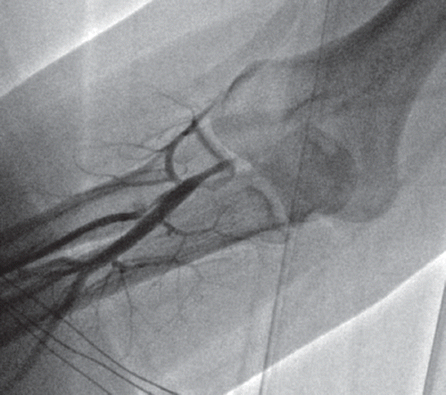 Figure 2. Radial artery spasm distally to bifurcation.