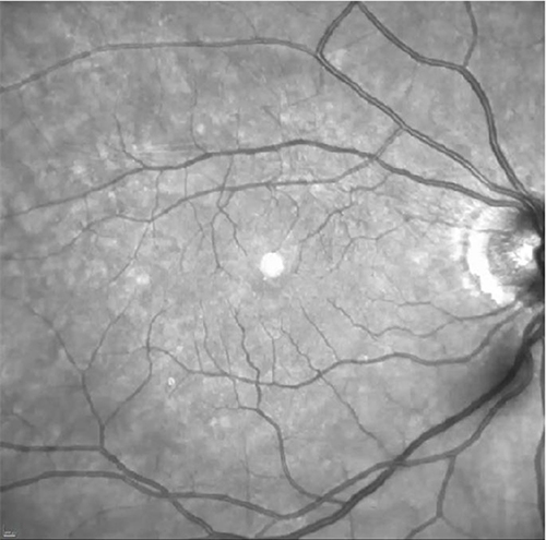 Figure 2 Infrared fundus picture of an asymptomatic patient with the characteristic less dense vitreous opacity located peripheral to the macula, in this case is over the optic nerve.