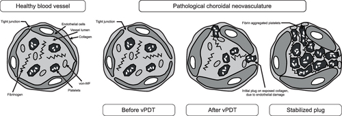 Figure 1 Mechanism of action of vPDT at the site of the blood vessel wall.Citation7 Verteporfin PDT induces endothelial damage, including rounding of endothelial cells, which allows for clotting factors to be released at the site of damage and subsequent recruitment of platelets that form an occlusion. Adapted from Debefve E, Pegaz B, van den Bergh H, Wagnieres G, Lange N, Ballini JP. Video monitoring of neovessel occlusion induced by photodynamic therapy with verteporfin (Visudyne), in the CAM model. Angiogenesis. 2008;11(3):235–243. Creative Commons.Citation7