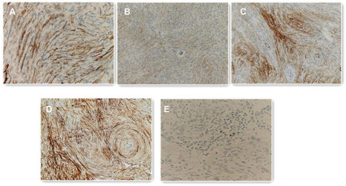 Figure 3 Immunohistochemical staining showing positive for CD34 ((A) original magnification, ×400), EMA ((B) original magnification,×200), Vimentin ((C) original magnification, ×200), SSTR2 ((D) original magnification, ×200), Ki-67 labeling index being approximately 1% ((E) original magnification, ×400).