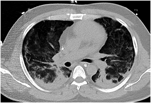 Figure 2. CT chest on hospital day 25 showing bilateral diffuse opacities