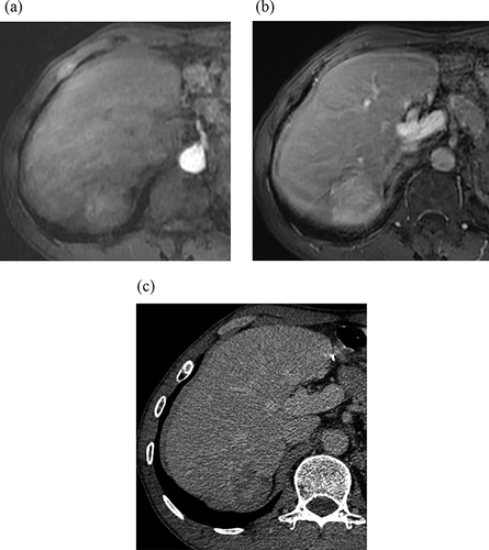 Figure 3 52-year-old man with cirrhosis and HCC. Figure (a) shows APHE of Gd-EOB-DTPA MRI. Figure (b) shows no washout and no capsule in PVP of Gd-EOB-DTPA MRI. Tumor diameter > 2cm, and LR-4. Figure (c) shows washout and enhancing capsule in delayed phase of CT. Adding CT delayed-phase images to Gd-EOB-DTPA MRI, the lesion was classified as LR-5.
