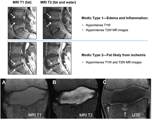 Figure 3 (Top) White arrows pointing to Modic changes appreciated on MRI T1/T2. (Bottom). (A) Midsagittal T1-weighted MRI; (B) T2-weighted MRI; and (C) ultra-short echo time (UTE) MRI, further elucidating endplate damage of L1-L2 motion segment. Reproduced with permission from Otz JC, Fields AJ, Liebenberg EC. The role of the vertebral end plate in low back pain. Global Spine J. 2013;3(3):153–164, Copyright 2013, SAGE Publication;Citation2 and Dudli S, Fields AJ, Samartzis D, Karppinen J, Lotz JC. Pathobiology of Modic changes. Eur Spine J. 2016;25(11):3723–3734, copyright 2016, Spring Nature.Citation55