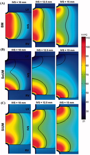 Figure 3. Temperature distribution in the tissue after 120 s of RFA across the interventricular septum (IVS) for different septum thickness from 10 to 15 mm, considering three modes of ablation: (A) bipolar mode (BM), (B) sequential unipolar mode (SeUM), and (C) simultaneous unipolar mode (SiUM). The solid black line is the thermal damage border (Ω = 1). RL: right ventricle, and LV: left ventricle.
