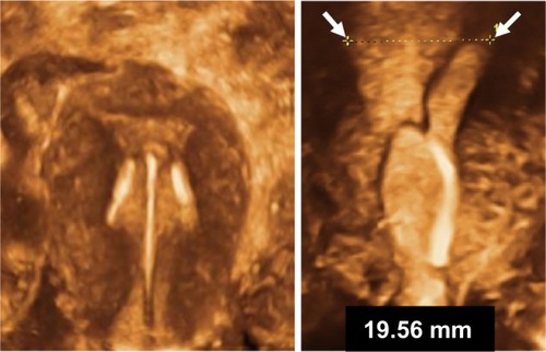 Figure 3 TCu 380A (ParaGard®, Duramed Pharmaceuticals Inc., Pomona, NY, USA) intrauterine device causing bleeding and pain due to severe disproportion (left, Courtesy of Dr Shipp, Department of Obstetrics and Gynecology, Brigham and Women’s Hospital, Harvard Medical School, Boston, MA, USA) and a levonorgestrel-releasing intrauterine device (Mirena® [Bayer, Berlin, Germany], right).