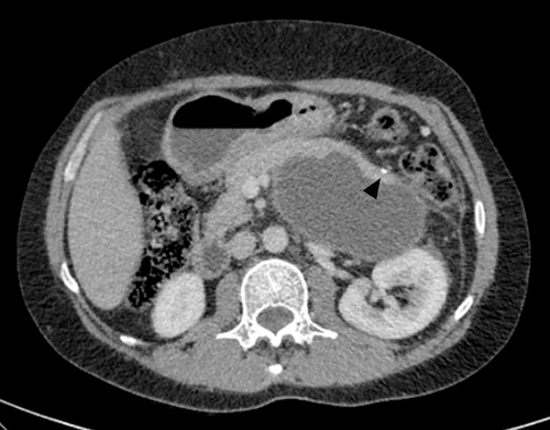 Figure 1 A pre-contrast axial CT image showed a homogeneously cystic lesion of the pancreatic body and tail. A single focus of punctate calcification (arrowhead) is present in the region of the pancreatic tail that does not contact the cyst wall. No hyperattenuating content was seen within the cyst.