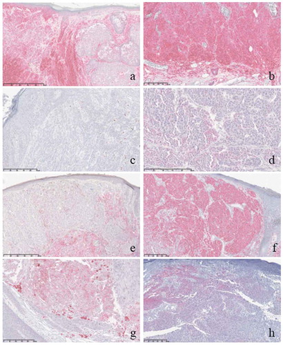 Figure 1. Examples of different immunohistochemical expressions in non-ulcerated primary melanomas (NUM) and ulcerated primary melanomas (UM).Legend: a. HLA class I expression in NUM, b. HLA class I expression in UM, c. MX-1 expression in NUM, d. MX-1 expression in UM, e. HLA class II expression in NUM, f. HLA class II expression in UM, g. iNOS expression in UM, h. CD47 expression in UM.