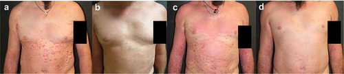 Figure 6. Representative images of outcome at the abdomen and chest region in Patient #6. A male patient aged 39 years with severe chronic plaque psoriasis. At baseline, PASI was 42 (A). After a few weeks with brodalumab, complete remission was achieved (B). After 56 weeks, treatment was suspended due to personal difficulties and excessive alcohol consumption and after 1 month the patient was erythrodermic (PASI 59) and with a compromised quality of life (C). He was engaged to change his lifestyle and also restarted brodalumab with a new cycle (without induction phase) and after 8 weeks PASI 75 was achieved with complete remission obtained after 16 weeks