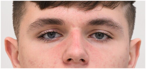 Figure 4. Patient wearing the artificial eye produced using the novel digital photographic technique (patient’s right eye).
