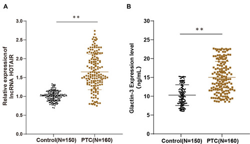 Figure 1 LncRNA HOTAIR and Glactin-3 were highly expressed in PTC. Fasting peripheral venous blood was collected immediately after patient admission. (A) LncRNA HOTAIR expression in serum of PTC group and benign thyroid tumor group was detected by RT-qPCR; (B) Galectin-3 expression in serum was detected using ELISA. The data were expressed as mean ± standard deviation. T test was used for comparison among groups. **P < 0.01.