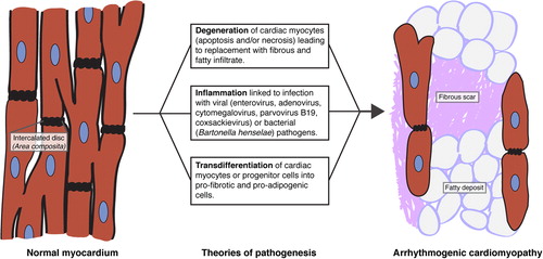 Figure 2. Theories of AC pathogenesis. AC may arise from cardiac myocyte degeneration, inflammation of myocardium from infection by cardiotropic pathogens, and/or transdifferentiation of cardiac myocytes or progenitor cells into fat- and fibrotic scar-producing cells (CitationBasso et al., 2011; CitationHerren et al., 2009).