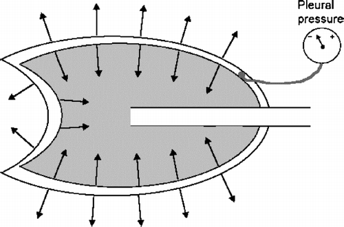 Figure 1 Cartoon of lung and chest wall with elastic tension represented by arrows. The difference between the tension of the two structures is the pleural pressure.