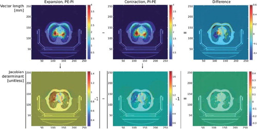 Figure 2. Comparison of PE→PI vs. PI→PE registrations in the 4D-CT image for Patient 1 with abdominal compression in the same CT slice. First row shows the vector size colour coded contour map for the DVF of the PE-PI registration (expanding direction), the PI-PE registration (contracting direction) and a difference maps showing the discrepancies between predicted lengths, all in millimetres. Second row shows the corresponding Jacobian maps and a difference map between these, calculated as the absolute value of Jacobians of the expanding direction DVF minus one, minus the absolute value of Jacobians of the contracting direction DVF minus one. (Note that the TPS rescales the 512 × 512 pixels CT images to 256 × 256 pixels when performing the DIR.)