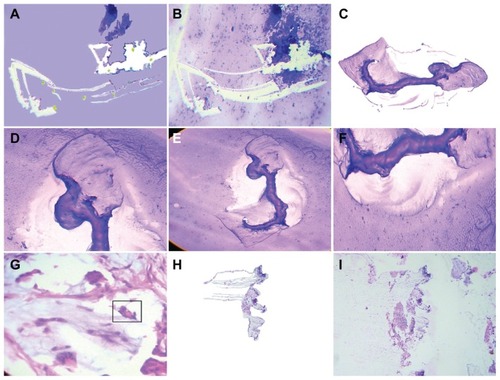 Figure 3 Close-up observation of scheduled short crystal migrations that guide and sculpt the surrounding silhouette characteristics of the embryo body with surprising precision. (A) Detachment subimage of (B) image, demonstrating geometric template platform guided by crystal displacement establishing head, tail positional identity in a case of endometrial adenocarcinoma, endocervical smear, Papanicolaou staining (40×). (C) Detachment panoramic subimage of (D, E, and F) which reveals in detail how short crystal migrations sculpting the surrounding embryoid body silhouette establish positional tissue ligands in a case of peritoneal carcinomatosis ascitic fluid. Papanicolaou staining (40×). (G) Well defined embryoid body in a case of breast adenocarcinoma with hematoxylin and eosin staining (20×). (H) Detachment subimage of (I) image which reveals embryoid body segmentation generated by massive crystal synchronic migrations in a case of undifferentiated necrotic tumor with hematoxylin and eosin staining (20×).