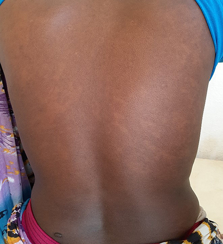 Figure 4 Shows fully recovered skin after a six-month follow-up visit.