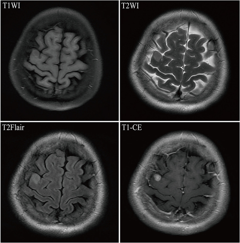 Figure 2 Magnetic Resonance Imaging (MRI) for breast cancer combined with brain metastasis in a 45-year-old female patient. T1WI revealed an irregular hypointense nodule in the right precentral gyrus; T2WI showed a slightly hyperintense signal; T2Flair demonstrated a hyperintense signal; and T1-CE displayed significant enhancement of the lesion.