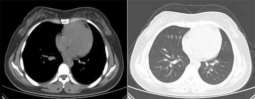 Figure 2 Chest CT images of the patient 4 weeks after discharge. Compared with the findings on the 3rd day of admission, there was decreased ground-glass opacity and patchy consolidation as well as thinner bronchovascular bundle in the both lungs. The heart shadow and pericardial effusion as well as pleural effusion were also reduced.