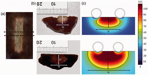 Figure 4. Thermal lesions created after 60 s of RF heating at 50 V (rms), considering a flow rate of 100 mL/min and a coolant temperature of 5°C. (a) Surface view of lesion created in the ex vivo model, (b) side views of lesions created in the ex vivo (top) and in vivo (bottom) models. (c) Temperature distributions from computer simulations of the ex vivo (top) and in vivo (bottom) conditions (scale in °C). The lesions were characterised by the depth (d) and maximum width (W) parameters. Experimental lesions were assessed by the white coagulation zone contour and in the computer simulations by an Arrhenius damage model (the solid black contour corresponds to Ω = 1).