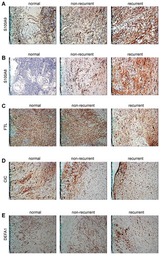 Figure 4. Verification of proteins expression level by immunohistochemistry. Expression of S100A9 (A), S100A8 (B), FTL (C), CIC (D), DEFA1 (E) in normal group, non-recurrent group of ovarian endometriosis cyst and recurrent group of ovarian endometriosis cyst; (DAB development, ×200).