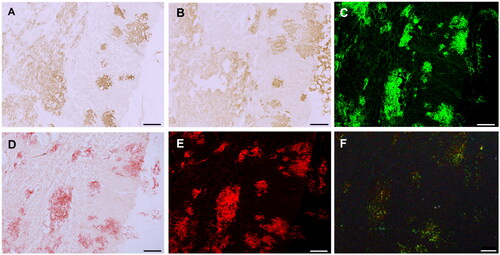 Figure 5. Amyloid-specific staining of cardiac TTR deposits. Sections of cardiac tissue with ATTR-V30M amyloidosis were stained with isoD38-TTR mAbs 2F2 (A) and 4D4 (B). Consecutive sections stained with thioflavin S (C) and Congo red (D) reveal amyloid deposits, confirmed by Congo red fluorescence (E) and Congo red polarisation (F). Scale bar = 250 µm.