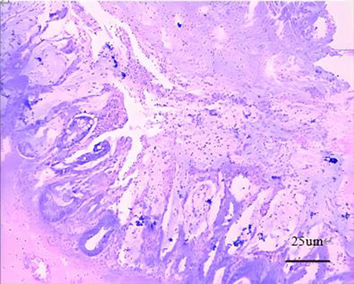 Figure 4 Colon pathology shows gangliocyte is normal.