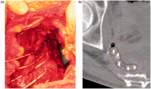 Figure 1. Postoperative interstitial pulsed dose rate brachytherapy (PDR-BT) in a patient with locally recurrent rectal cancer with high risk of R1 resection. (a) Catheters for brachytherapy sutured to the tumour bed. The catheters were later covered by a pediculated myocutaneous flap (rectus abdominis) preventing direct contact between the intestines and the high dose volume. (b) Treatment plan delivering 30 Gy (cyan contour) given with 0.6 Gy per pulse, one pulse per hour to the BT target (red contour). Dose planning was conducted with manual dose optimisation avoiding overlap of double dose volumes i.e., 60 Gy (yellow contour).