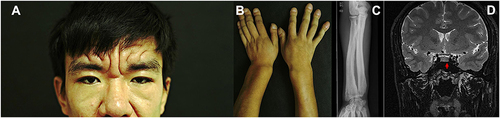 Figure 1 Skin furrowing and thickening, biliteral eyelids ptosis (A), digital clubbing of the fingers (B), radiographic examination showed cortical thickening in the long bones (C), contrast-enhanced magnetic resonance imaging of the pituitary revealed a hypointense signal on T2-weighted images (3×5mm) (D).