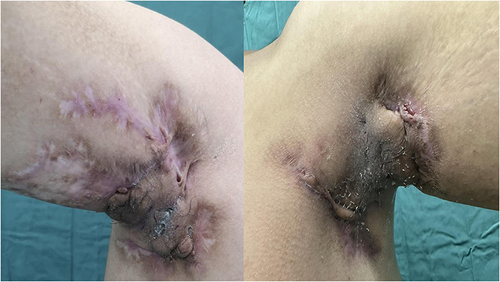 Figure 2 After 24 weeks of secukinumab therapy.