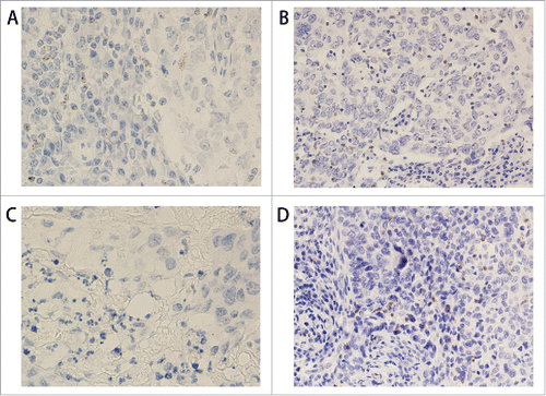 Figure 3. PD1 protein and mRNA staining in triple negative breast cancer. (A) RNAscope shows PD1 mRNA expression in TILs (400x). (B) IHC shows PD1 protein expression in the same case as in A (200x). (C) RNAscope shows negative PD1 mRNA expression in TILs (400x). (D) IHC shows PD1 protein expression in the same case as in C (200x).