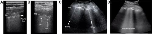 Figure 6 Pediatric lung ultrasound findings in COVID-19. (A) An irregular pleural line seen at rib interspaces. (B) Subpleural consolidations (SPC) originating from the pleural line. (C) Isolated B-lines originating from the pleural line. (D) Confluent B-lines originating from the pleural line.