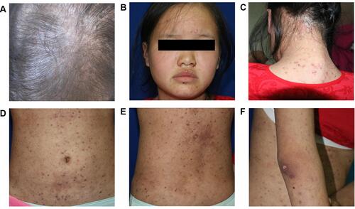 Figure 1 Clinical manifestations and H&E staining before diagnosis of syphilis. (A) Thinning hair on the vertex with scattered erythema and papules on the scalp; (B) numerous scattered erythema and papules on the face; (C) lots of hypertrophic plaques with white scales on the occipital scalp and neck; (D–F) scattered erythema and papules on the trunk (D and E) and extremities (F), some of the lesions showed necrosis and escharosis. Hyperpigmentation was presented.