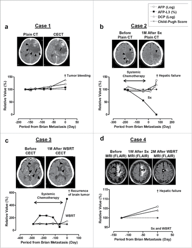 Figure 1. CT and/or MRI images of brain tumor and clinical courses of Case 1 (a), Case 2 (b), Case 3 (c), and Case 4 (d). CECT, contrast enhanced CT; Sx, surgical resection; WBRT, whole brain radiation therapy. Black arrowheads indicate area of swelling. Black arrows indicate tumors and bleeding from the tumor. White arrowheads indicate the change after Sx and WBRT. AFP and DCP are monitored its increment ratio using their log value and comparing with the initial value available in our hospital. AFP-L3 (%) and Child-Pugh score were monitored for its changes from initial value.