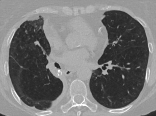 Figure 1 Multidetector computed tomography image.Note: Lobar atelectasis of the right lower lobe following valve implantation.