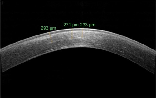 Figure 3 AS-OCT of keratoconus eye 6 months after accelerated epi-off corneal cross-linking radiating with UV-A at 10 mW/cm2.