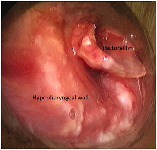Figure 4. Remaining pectoral fin in the left hypopharynx.