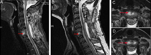Figure 5 Postoperative MRI. (A) Sagittal fat-suppressed MRI image; (B) sagittal T2-weighted MRI image; (C) Axial MRI image of the C6 vertebra; (D) Axial MRI image of the C7 disc space. Red arrows indicate hyperintense signals in vertebral bodies and paravertebral tissue.