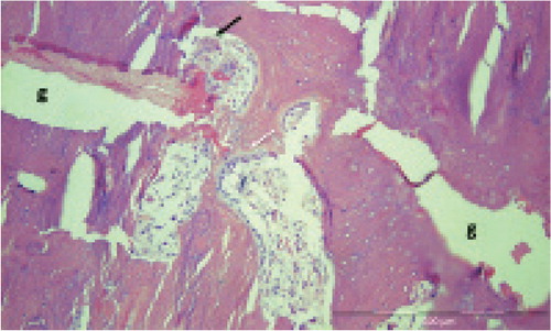 Figure 7. Remodeling bridging the fracture gap (g) in case 6. Black arrow: osteoclast. White arrow: osteoblasts.