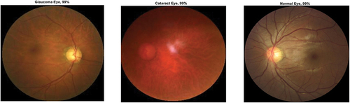 Figure 9. Ocular disease classification using darknet-53 (batch size-6, optimizer-sgdm) (with augmented image data).