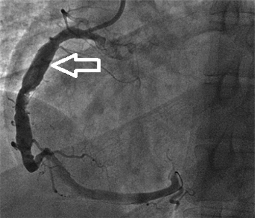 Figure 2. Coronary angiogram showing severe ectasia of right coronary artery (RCA) (see the white arrow).