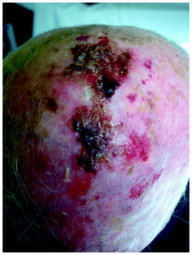 Figure 2. Field cancerization on scalp of an elderly man, with multiple actinic keratoses and histologically confirmed SCCs.